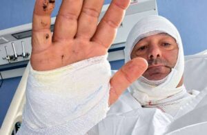 Scopri di più sull'articolo Agrigento – Avvocato aggredito con l’acido: arrestata 47enne
